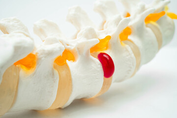 Lumbar spine displaced herniated disc fragment, spinal nerve and bone. Model for treatment medical...