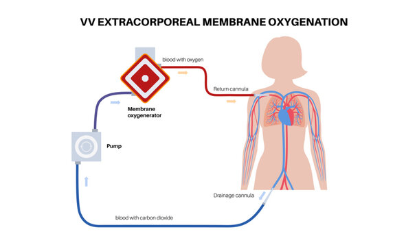 Extracorporeal membrane oxygenation
