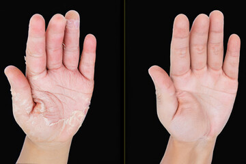 One man hand with psoriasis on it and the other man hand with healthy skin.