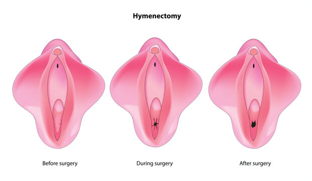 Hymenectomy