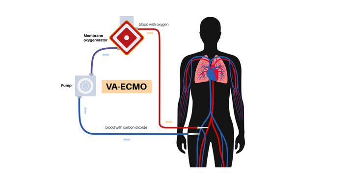 Extracorporeal membrane oxygenation