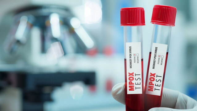 Close-up of Mpox virus test tubes in a laboratory, perfect for health and medical research themes.