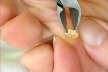 Woman cutting out a callus on the foot