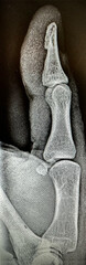 Thumb X-ray