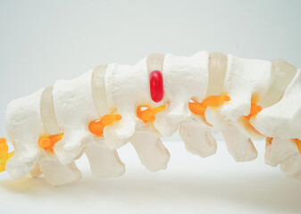 Spinal nerve and bone, Lumbar spine displaced herniated disc fragment, Model for treatment medical in the orthopedic department.