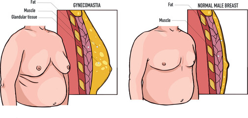 Gynecomastia Man Obesity with fat tissue on the chest comparison with normal the disorder in medical