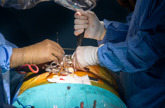 Surgeons who perform spinal cord surgery. Close up surgery team operating in modern hospital