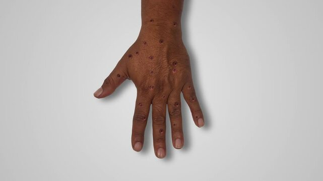 Hand Acquired Viral Monkeypox Lesion Syndrome