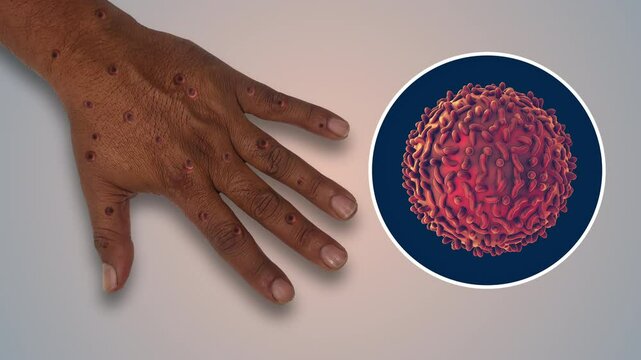 Viral Monkeypox Hand Lesion Infection Disorder