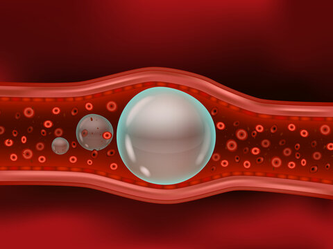 An air embolism, also called a gas embolism. Air bubbles enter a vein or artery and block it.