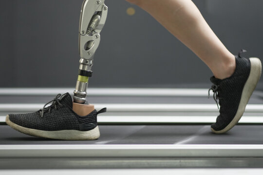 prosthetic, artificial leg. Woman with prosthetic leg using walking on treadmill while working out in gym. artificial leg. Woman wearing prosthetic equipment sit down after exercising in gym.