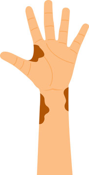 World Leprosy Day Hands