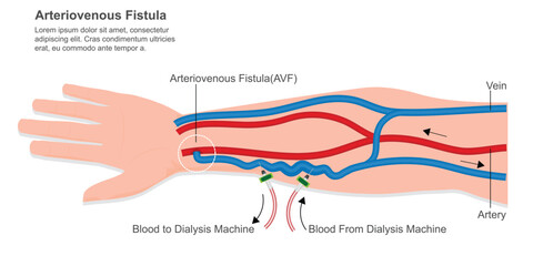 Arteriovenous fistula is surgical procedure in which small incision.