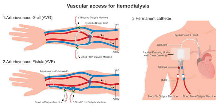 Vascular access for hemodialysis.
