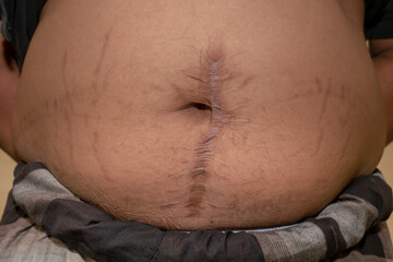 An obese man shows an appendicitis scar on his abdomen, a scar from appendicitis surgery on his...