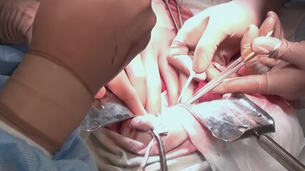 Expert hands work meticulously to perform life-saving heart surgery on a newborn, showcasing the skill and dedication of the surgical team in a crucial medical setting.