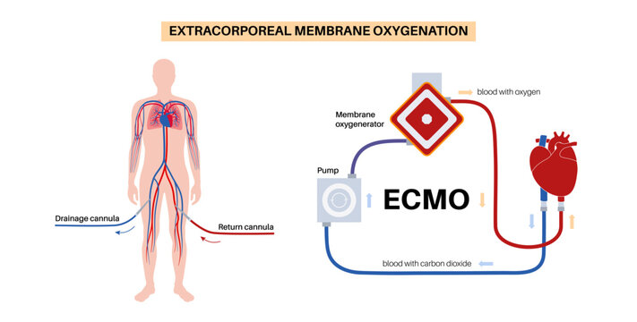 Extracorporeal membrane oxygenation