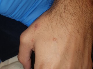 Naklejka premium Monkeypox disseminated skin lesions - gay white male