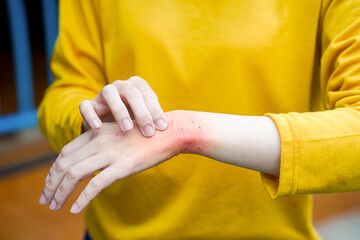 Close-up of a woman's arm showing fresh cat bite marks, while wearing a yellow shirt, illustrating pet-related injuries.