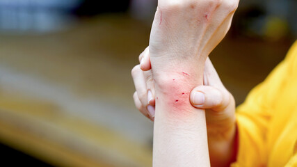 Close-up of a hand showing skin irritation, redness, and rashes on the arm. Perfect for medical and...
