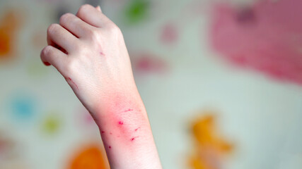 Close-up of a hand with red, irritated skin and scratches, showing signs of an allergic reaction or...