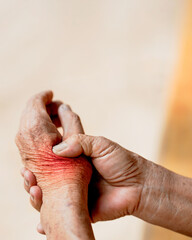Fototapeta premium Close-up of a person massaging their painful arthritic hand. The redness indicates inflammation and discomfort.