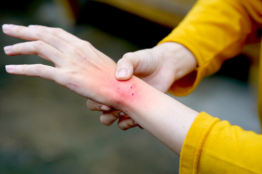 Close-up of a woman's arm showing fresh cat bite marks, while wearing a yellow shirt, illustrating pet-related injuries.