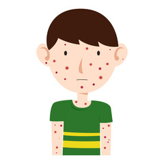 chicken pox virus infection disease