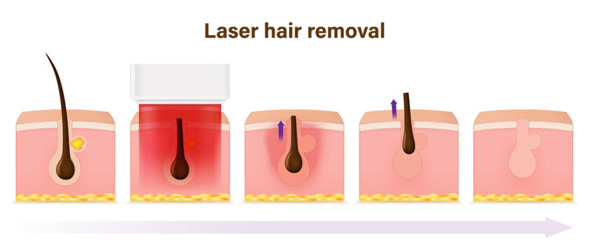 Laser hair removal. Hair characteristics before and after laser hair removal. Diode, YAG (Long Pulsed Nd Yag) and Alexandrite laser.
