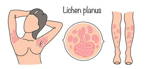 Lichen planus