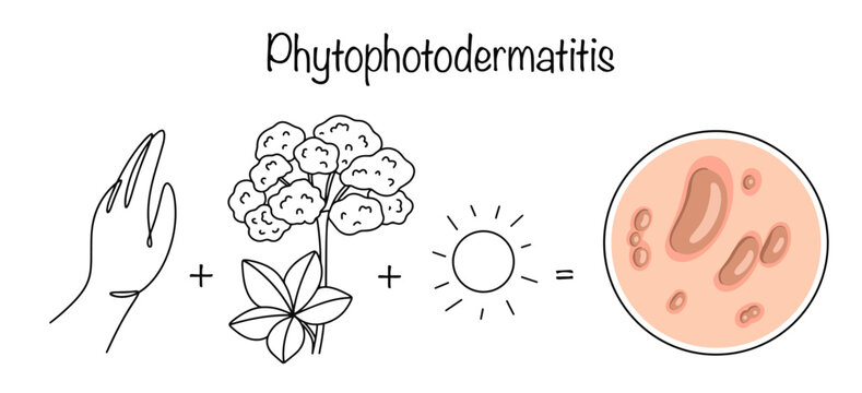 Phytophotodermatitis