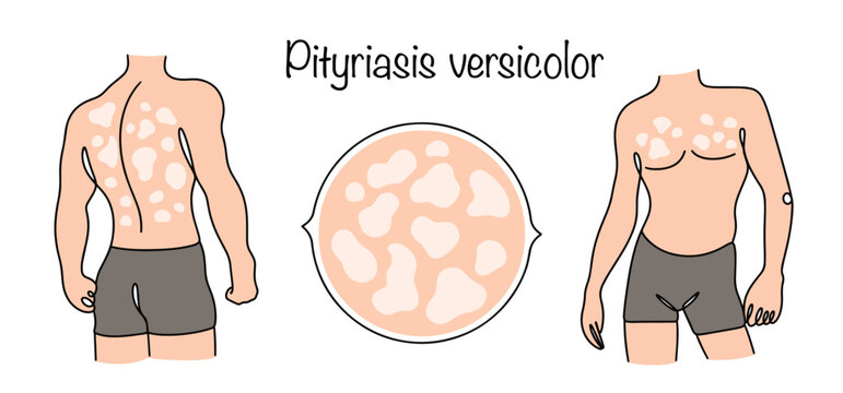 Pityriasis versicolor