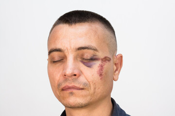 Fototapeta premium Male athlete mixed martial arts fighter without rules eye injury.