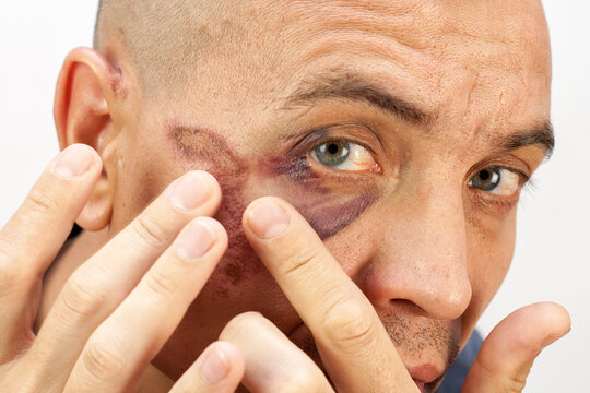 Male athlete mixed martial arts fighter without rules with eye injury.