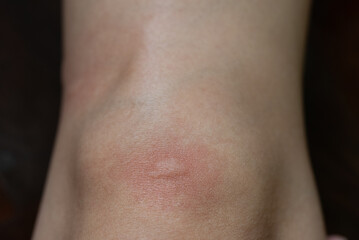 Close up View of Urticarial Rash From Mosquito Bite at Knee