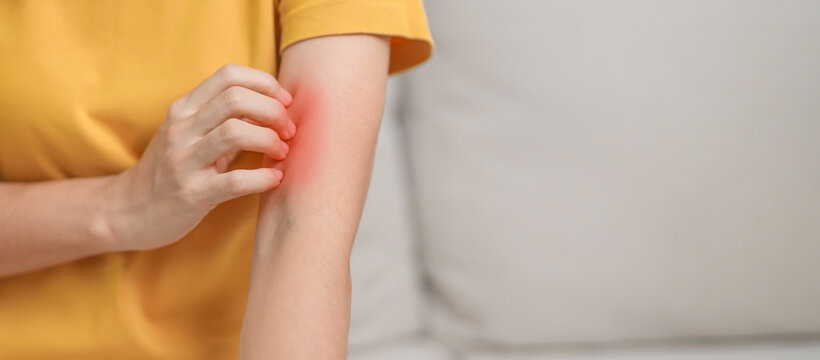 woman itching and scratching itchy arm. Sensitive Skin Allergic reaction to insect bite, food, drug dermatitis. Dermatology, Leprosy day, Systemic lupus erythematosus, Allergy symptoms and rash Eczema