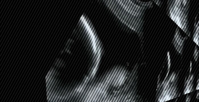 Ultrasoound echography in a multi screen