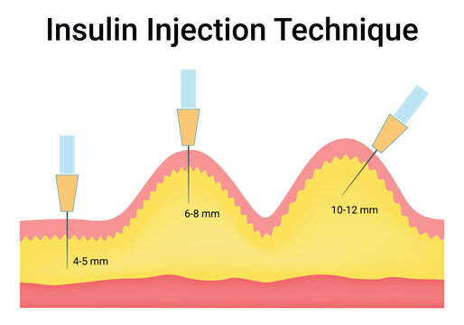 Insulin Injection Technique Images – Browse 269 Stock Photos, Vectors ...