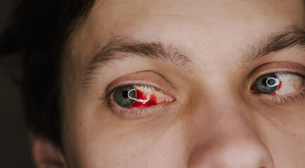 Obraz premium Human eye with subconjunctival hemorrhage showing visible red blood vessels and irritation, close up.