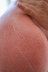 Fototapeta premium sunburn on the skin of a man. swollen skin from blisters on the boy's shoulder. red skin he has an overabundance of sun. sunburn at a dangerous hour