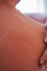Fototapeta premium sunburn on the skin of a man. swollen skin from blisters on the boy's shoulder. red skin he has an overabundance of sun. sunburn at a dangerous hour