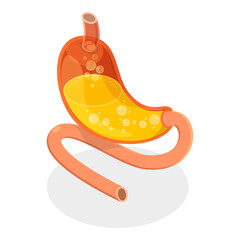 3D Isometric Flat Vector Set of Stomach Problems, Digestive System Issues. Item 3