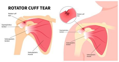 Shoulder joint bone of the upper arm and Degenerative rotator cuff muscle tear disease or injury
