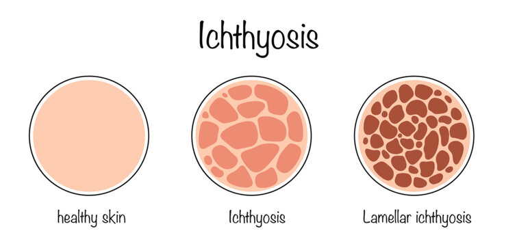 Ichthyosis