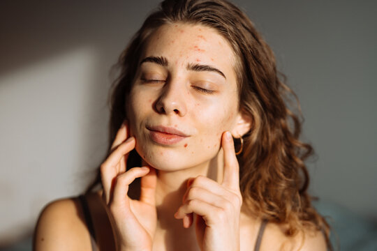 A young woman touches her face while gazing off to the side, showcasing her natural beauty along with skin imperfections. Medicine and cosmetology concept. Natural skin.