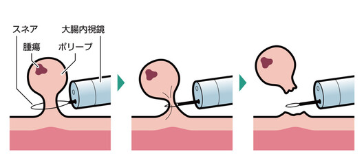 内視鏡的ポリープ切除術　図解