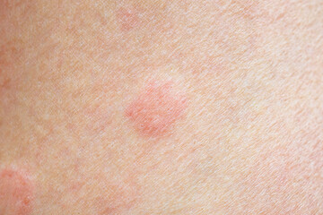 Fototapeta premium Skin allergy rash dermatitis texture close up background