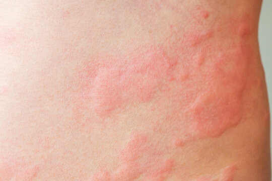 Skin allergy rash dermatitis texture close up background