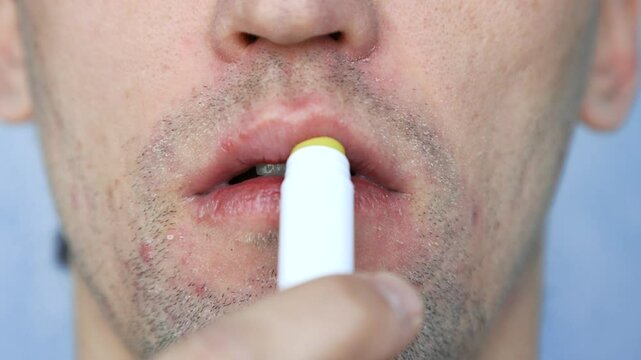 A close-up of a man who uses hygienic lipstick to moisturize cracked, dry lips. Side effect of acne medications: dry skin, chapped lips, itching. Removal of symptoms.