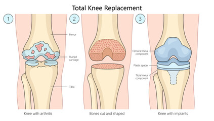 total knee replacement surgery, progression from arthritis-damaged knee to bone shaping and implant placement diagram hand drawn schematic vector illustration. Medical science educational illustration